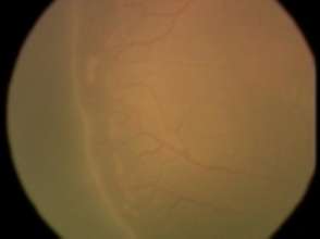 Baby of Vinutha - EYE FUNDUS Photo SHOWING ROP