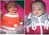 Pair of twins treated