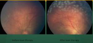 ROP - Pre and post laser photos