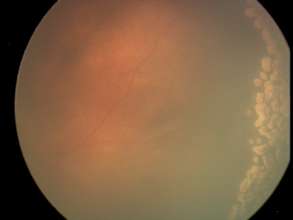 Regressed ROP Fundus Photo post treatment