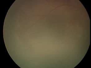 ROP stage 2 eye fundus photo