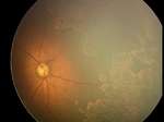 AP-ROP fundus photo