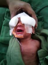 Baby of Nilafar - treated with antivegf injection