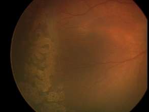 Baby of Vinutha-EYE FUNDUS PHOTO POST LASER TRTMT