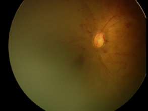 fundus image of APROP