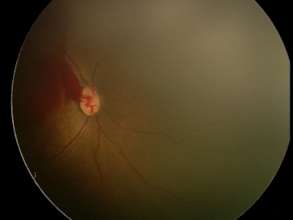 fundus image of pre retinal haemorrhage
