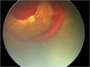 APROP fundus photo