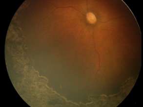 fundus photo post ROP laser photo