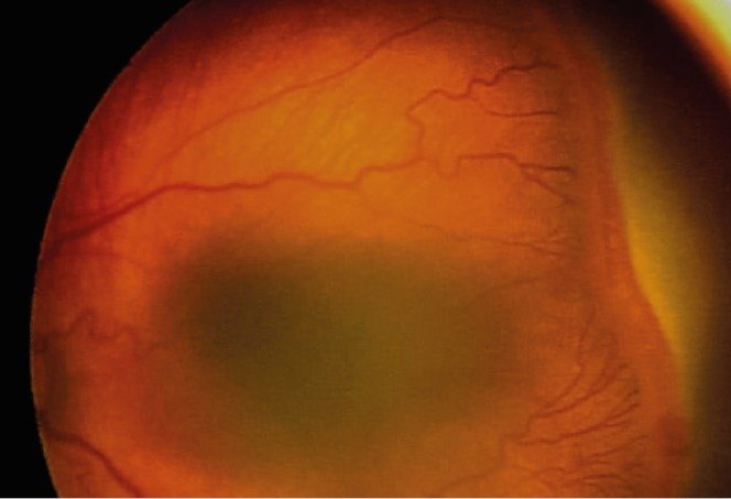 fundus photo of stage 3 rop
