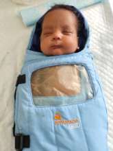 9 weeks old baby treated for rop