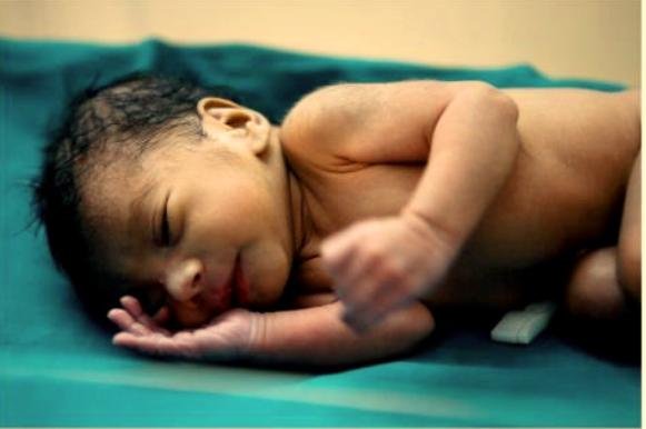 Eye Screening for Premature Babies