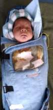 7 weeks male baby treated with laser