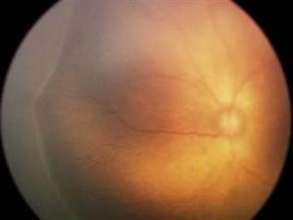 ROP stage 2 Fundus Photo