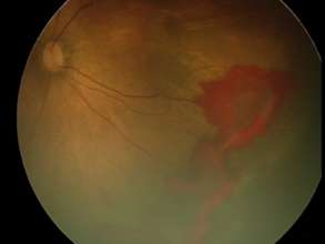 ROP fundus photo with preretinal haemorrhage