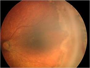 Fundus Photo of Baby of Jyothi showing stage 4 ROP