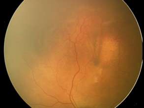 stage 2 ROP fundus photo