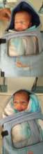 twin babies treated for ROP