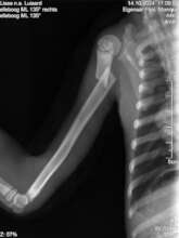 A severe fracture in Lisa's upper arm