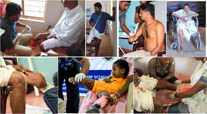 To provide 250 Free Artificial Limbs to Amputees