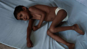 A severely malnourished Laxmi