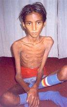 Sumitra at admission to a Nutritional Rehabilitation Home...