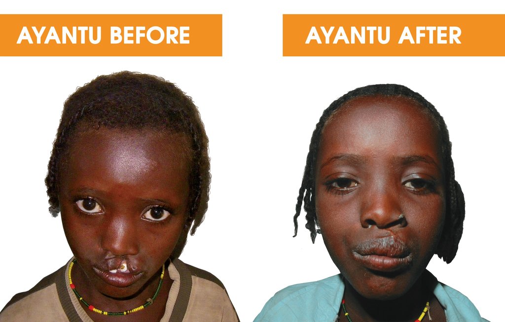 Help 40 Ethiopian Children with Cleft Conditions
