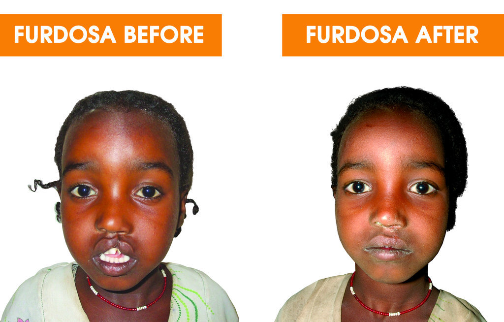 Help 40 Ethiopian Children with Cleft Conditions