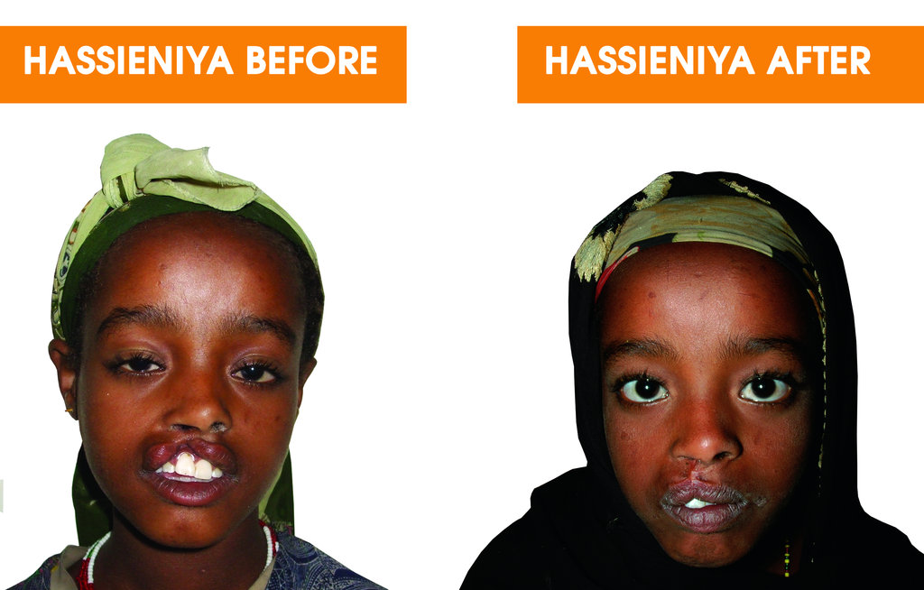 Help 40 Ethiopian Children with Cleft Conditions