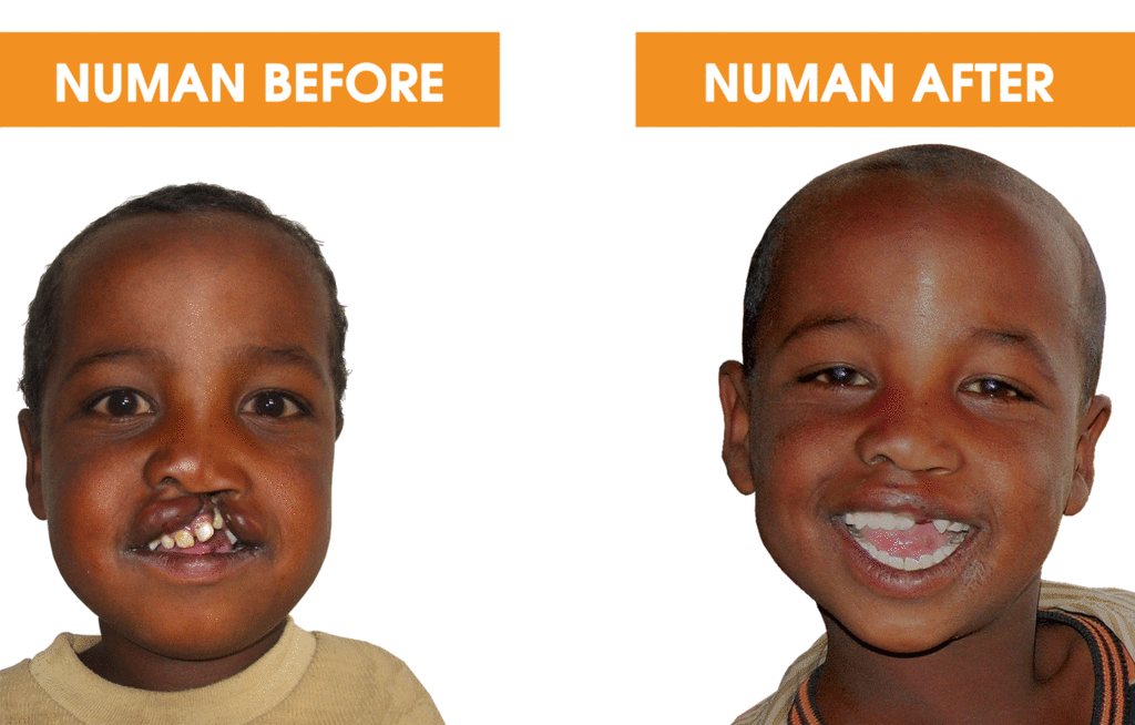 Help 40 Ethiopian Children with Cleft Conditions