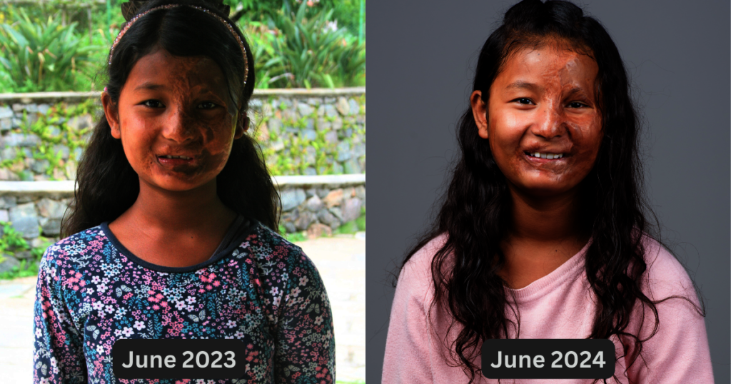 Bipana's Burn Scar Treatment Progress
