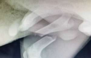 An x-ray showing Freddy's broken femur