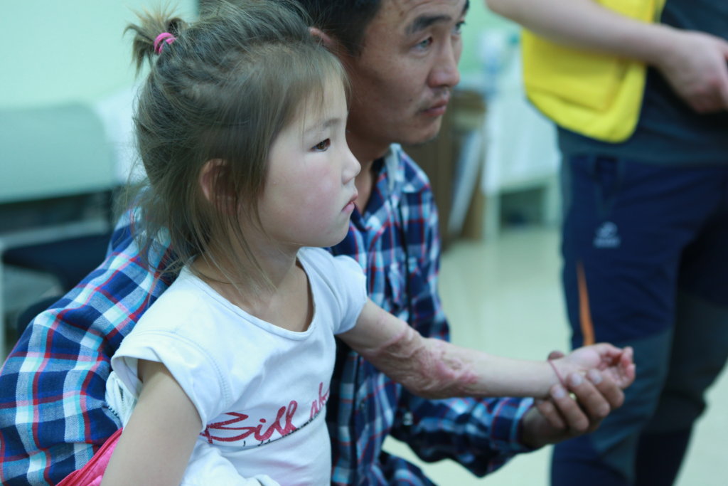 Support 32 burned Children in Mongolia