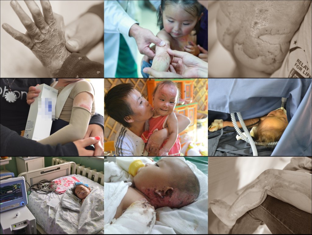 Support 32 burned Children in Mongolia