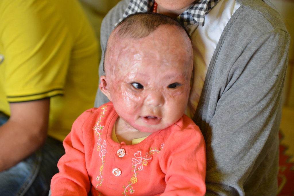 Support 32 burned Children in Mongolia