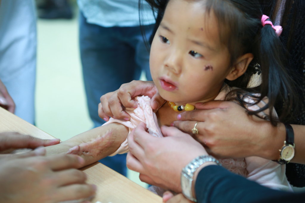 Support 32 burned Children in Mongolia