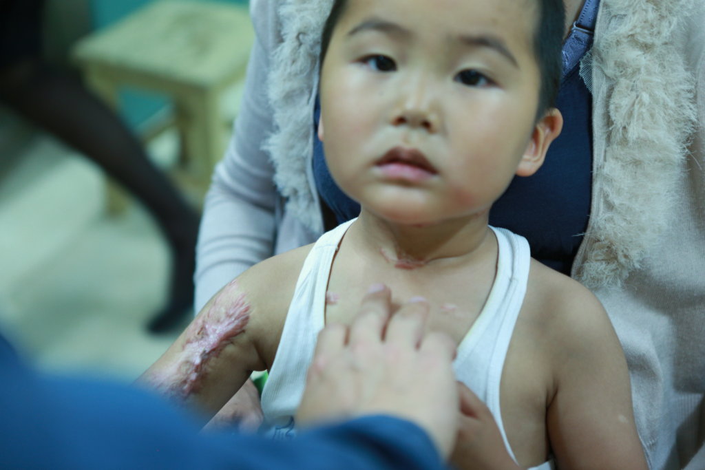 Support 32 burned Children in Mongolia