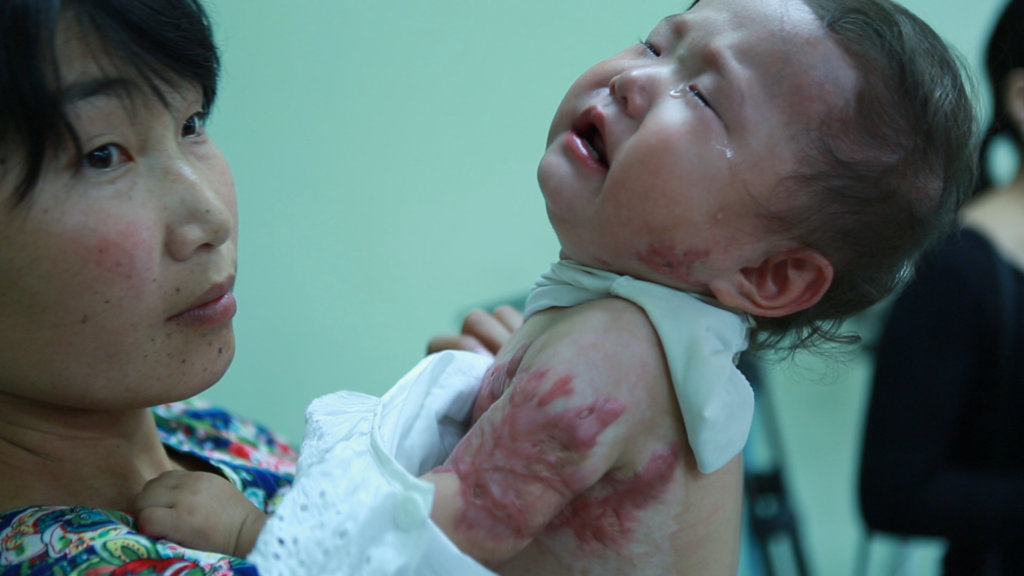 Support 32 burned Children in Mongolia