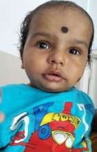 1 yr old baby operated for nuclear cataract
