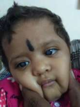 1 yr old baby operated for cataract