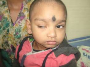 3 yr old operated for Ptosis