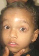 3 yr old male child operated for limbal dermoid