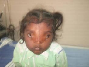 4 yr old boy operated for rare eye condition