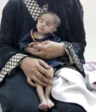 7 months old baby operated for lamellar cataract