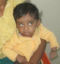 8 months old baby operated for lens opacities