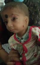 9 months old child operated for medial coloboma