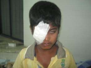 9 YR OLD BOY OPERATED FOR DEVELOPMENTAL CATARACT