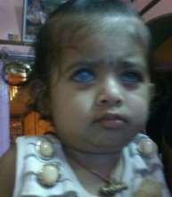 1 YR OLD GIRL CHILD OPERTD FOR ANIRIDIA + GLAUCOMA