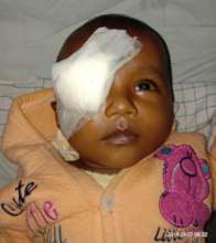 5 mn old baby operated for developmental cataract