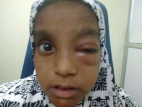 female child operated for orbital cellulitis