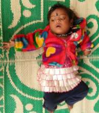child operated for congenital cataract